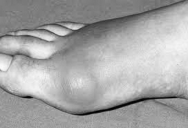 Health and Wellness – Got the Gout? Learn more